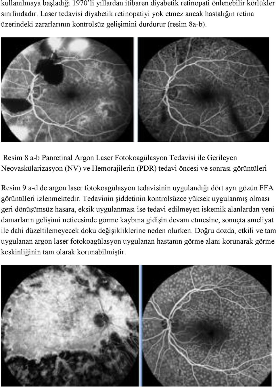 Resim 8 a-b Panretinal Argon Laser Fotokoagülasyon Tedavisi ile Gerileyen Neovaskülarizasyon (NV) ve Hemorajilerin (PDR) tedavi öncesi ve sonrası görüntüleri Resim 9 a-d de argon laser