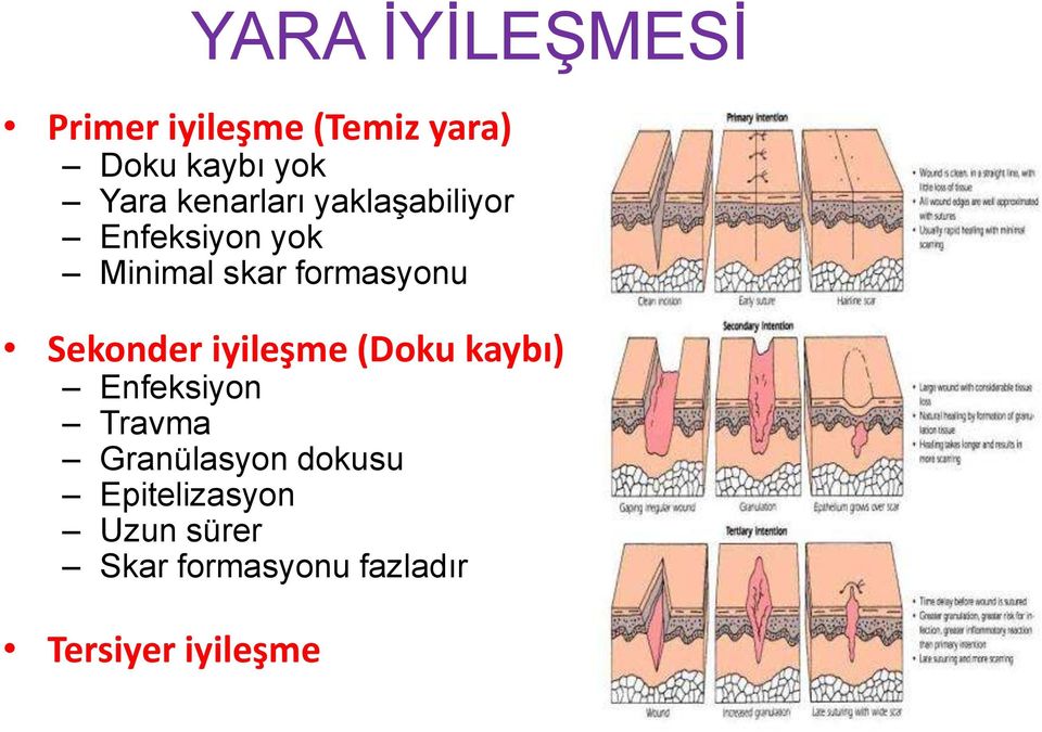 Sekonder iyileşme (Doku kaybı) Enfeksiyon Travma Granülasyon