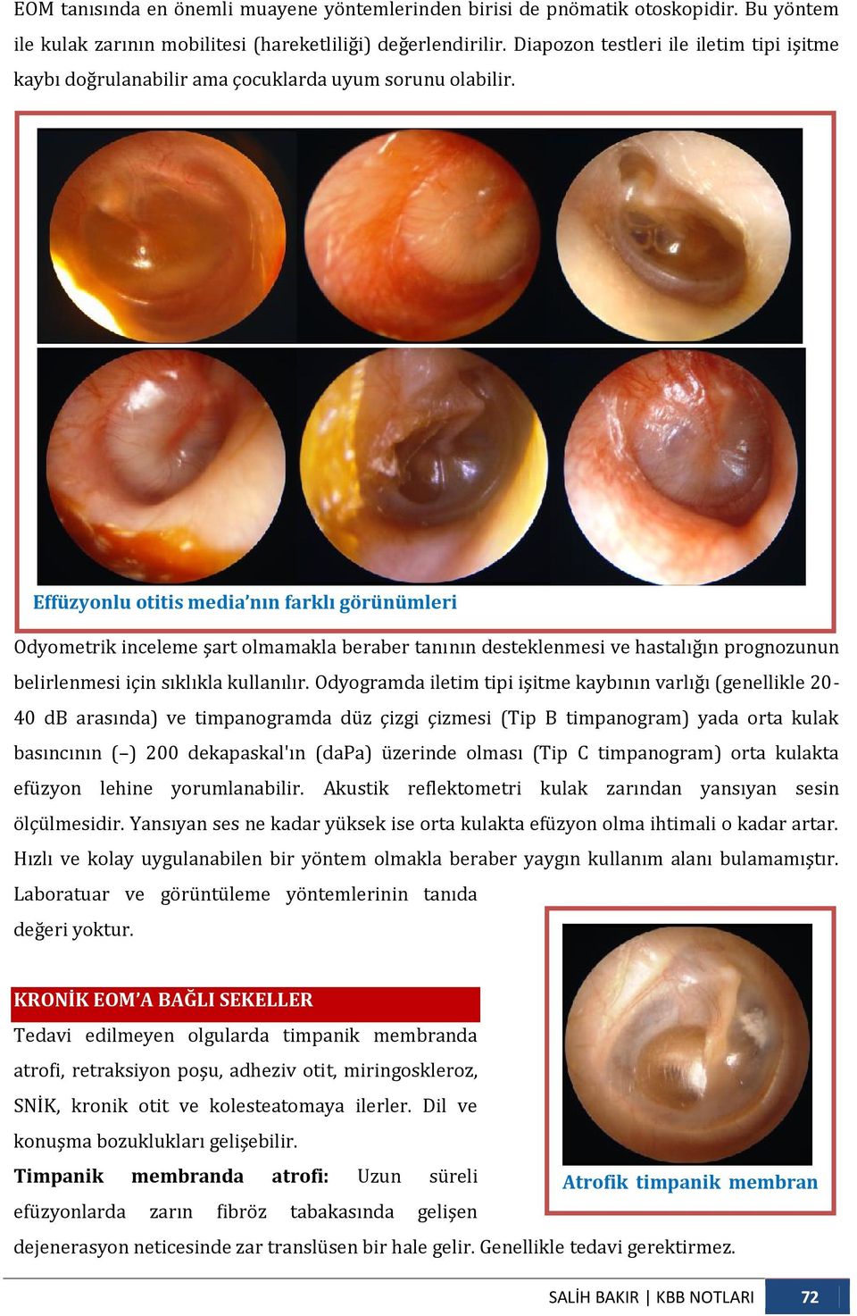 Effüzyonlu otitis media nın farklı görünümleri Odyometrik inceleme şart olmamakla beraber tanının desteklenmesi ve hastalığın prognozunun belirlenmesi için sıklıkla kullanılır.