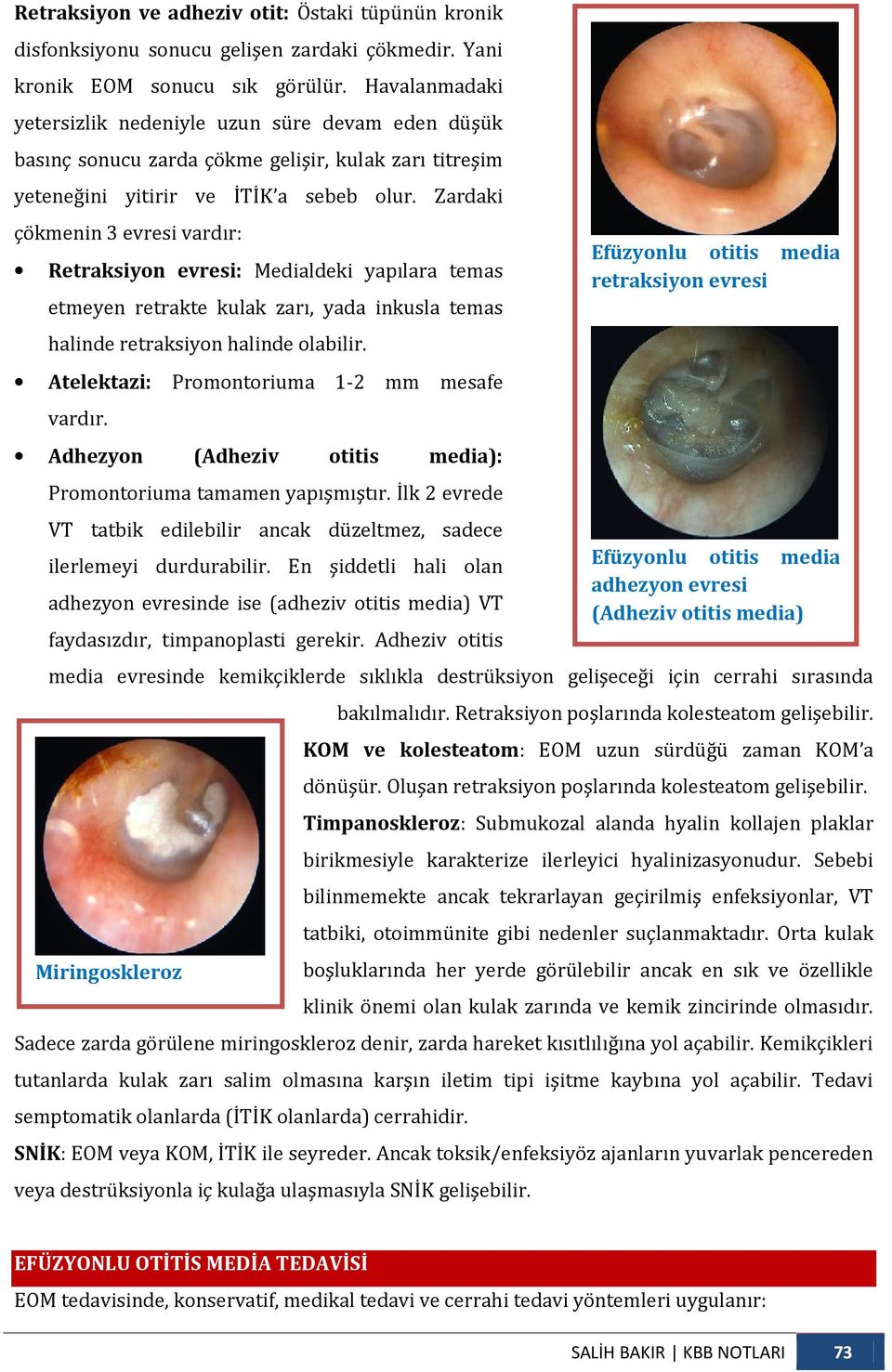 Zardaki çökmenin 3 evresi vardır: Retraksiyon evresi: Medialdeki yapılara temas Efüzyonlu otitis media retraksiyon evresi etmeyen retrakte kulak zarı, yada inkusla temas halinde retraksiyon halinde