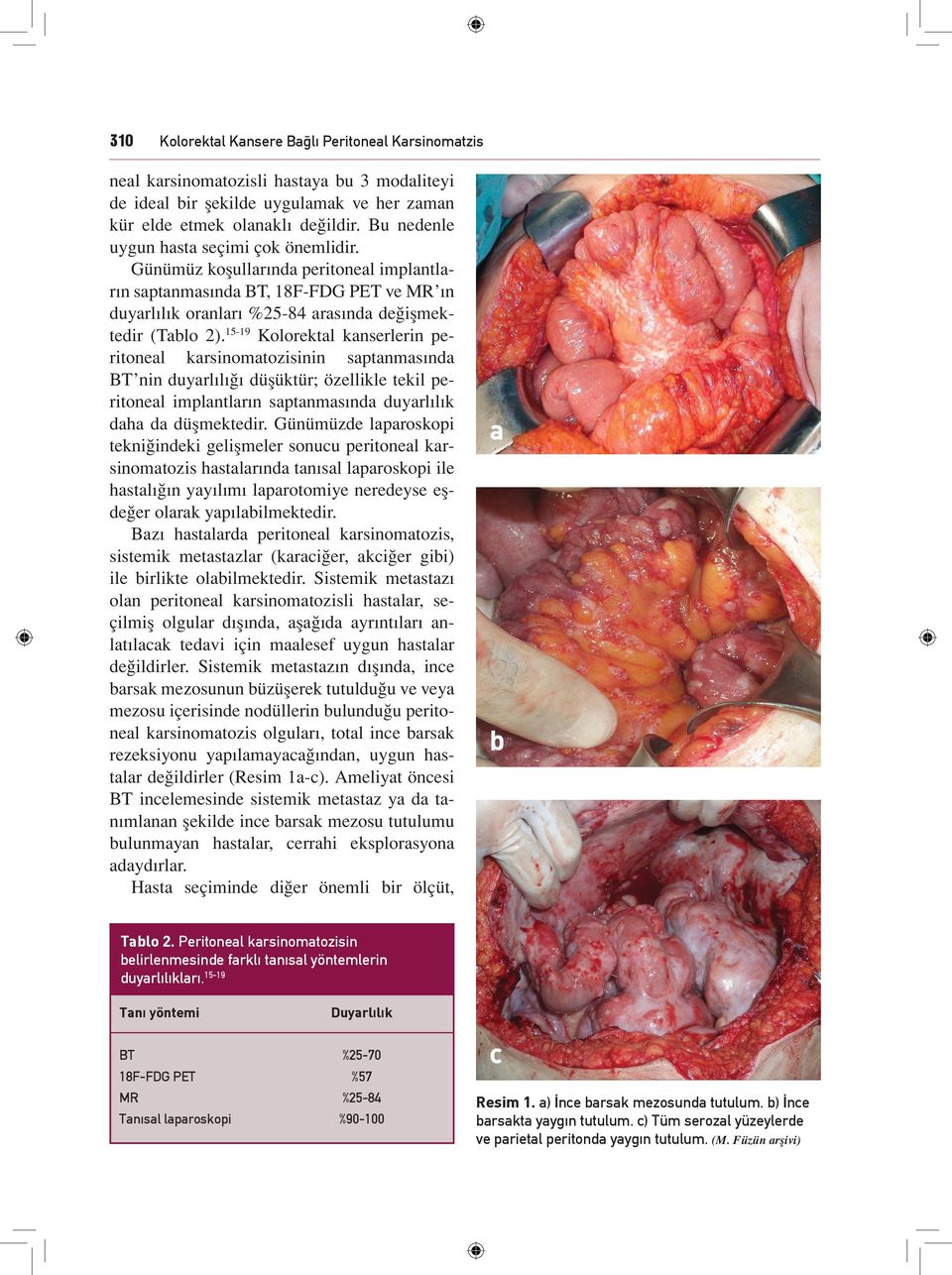 1519 Kolorektal kanserlerin peritoneal karsinomatozisinin saptanmasında BT nin duyarlılığı düşüktür; özellikle tekil peritoneal implantların saptanmasında duyarlılık daha da düşmektedir.