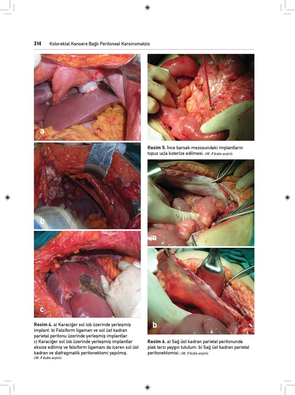 b) Falsiform ligaman ve sol üst kadran parietal peritonu üzerinde yerleşmiş implantlar.