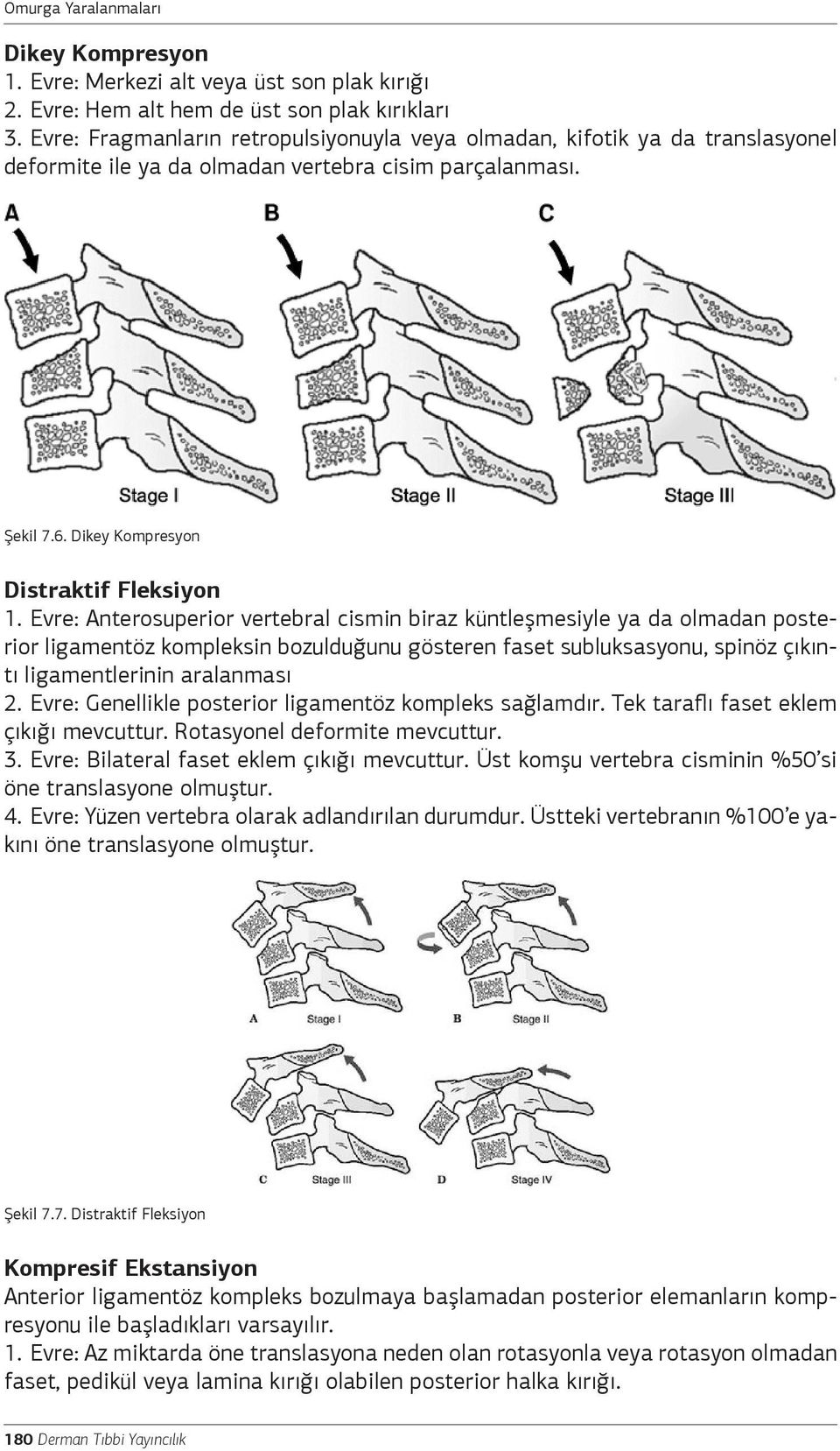 Evre: Anterosuperior vertebral cismin biraz küntleşmesiyle ya da olmadan posterior ligamentöz kompleksin bozulduğunu gösteren faset subluksasyonu, spinöz çıkıntı ligamentlerinin aralanması 2.