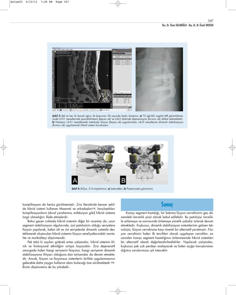 b) Hastaya; L5-S1 mesafesinde interbody füzyon (beyaz ok) uygulan rken, L4-L5 mesafesine dinamik stabilizasyon (k rm z ok) uygulanarak hibrid sistem kurulmufltur.