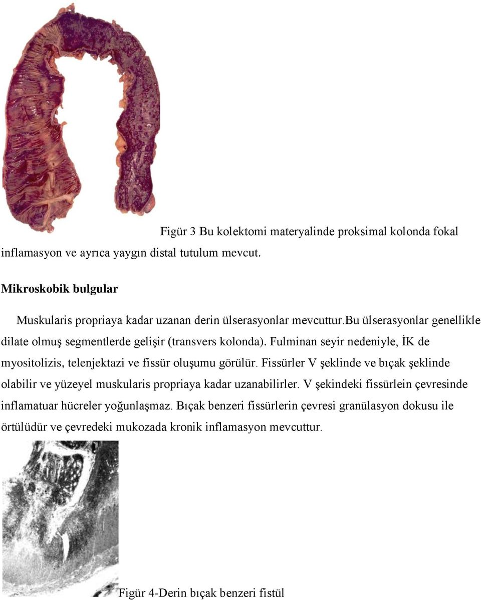 bu ülserasyonlar genellikle dilate olmuş segmentlerde gelişir (transvers kolonda). Fulminan seyir nedeniyle, İK de myositolizis, telenjektazi ve fissür oluşumu görülür.