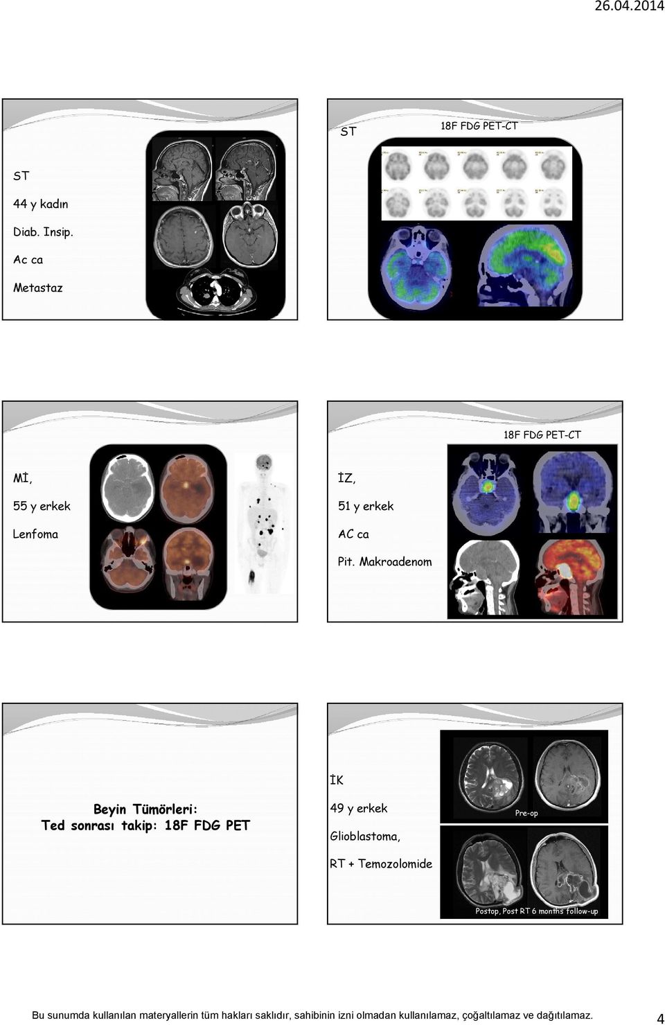 Pit. Makroadenom Beyin Tümörleri: Ted sonrası takip: 18F FDG
