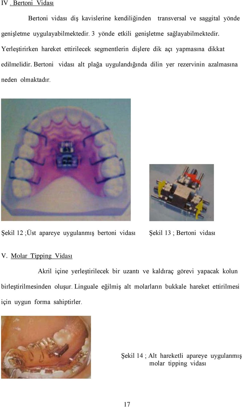 Bertoni vidası alt plağa uygulandığında dilin yer rezervinin azalmasına neden olmaktadır. Şekil 12 ;Üst apareye uygulanmış bertoni vidası Şekil 13 ; Bertoni vidası V.