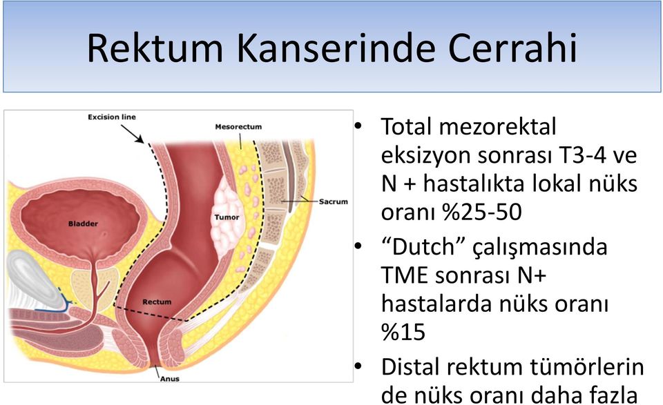 %25-50 Dutch çalışmasında TME sonrası N+ hastalarda