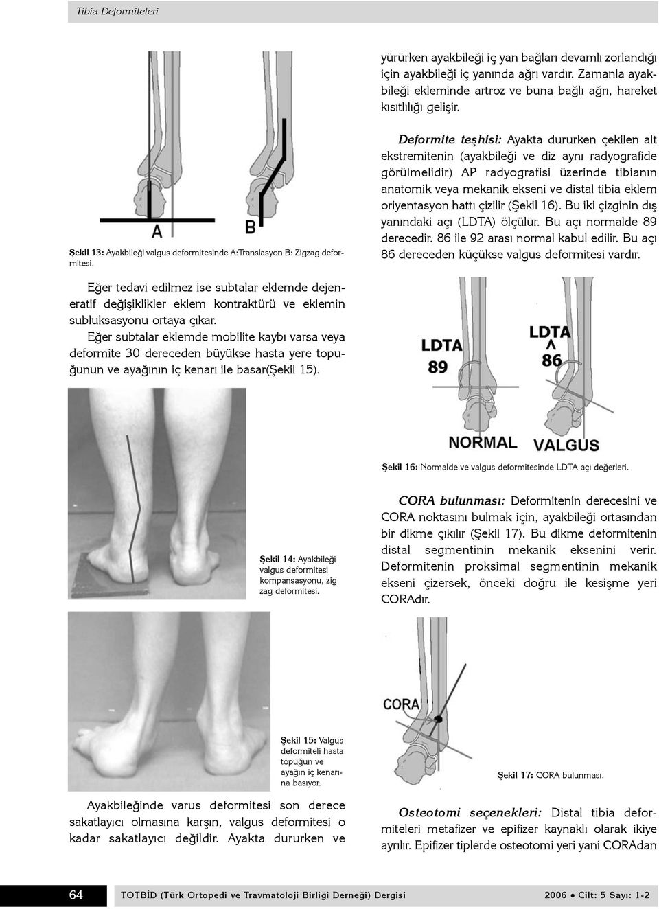 Deformite teþhisi: Ayakta dururken çekilen alt ekstremitenin (ayakbileði ve diz ayný radyografide görülmelidir) AP radyografisi üzerinde tibianýn anatomik veya mekanik ekseni ve distal tibia eklem