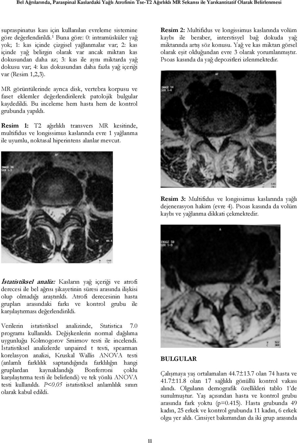 kas dokusundan daha fazla yağ içeriği var (Resim 1,2,3). Resim 2: Multifidus ve longissimus kaslarında volüm kaybı ile beraber, interstisyel bağ dokuda yağ miktarında artış söz konusu.
