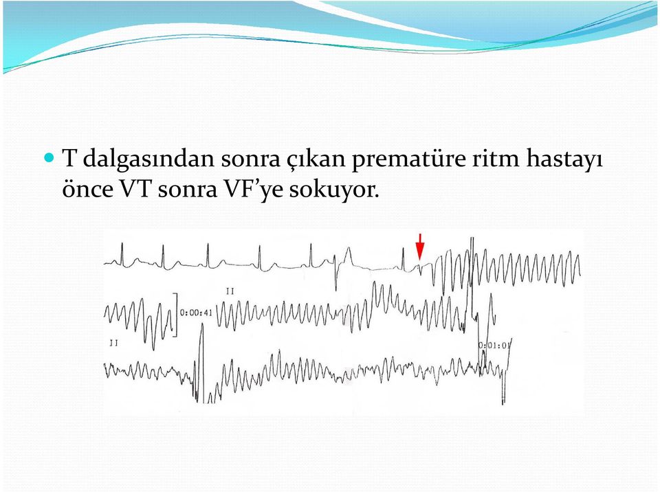 ritm hastayı önce