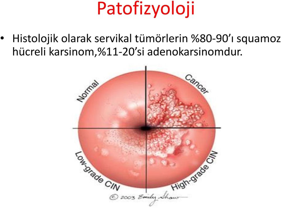 %80-90 ı squamoz hücreli
