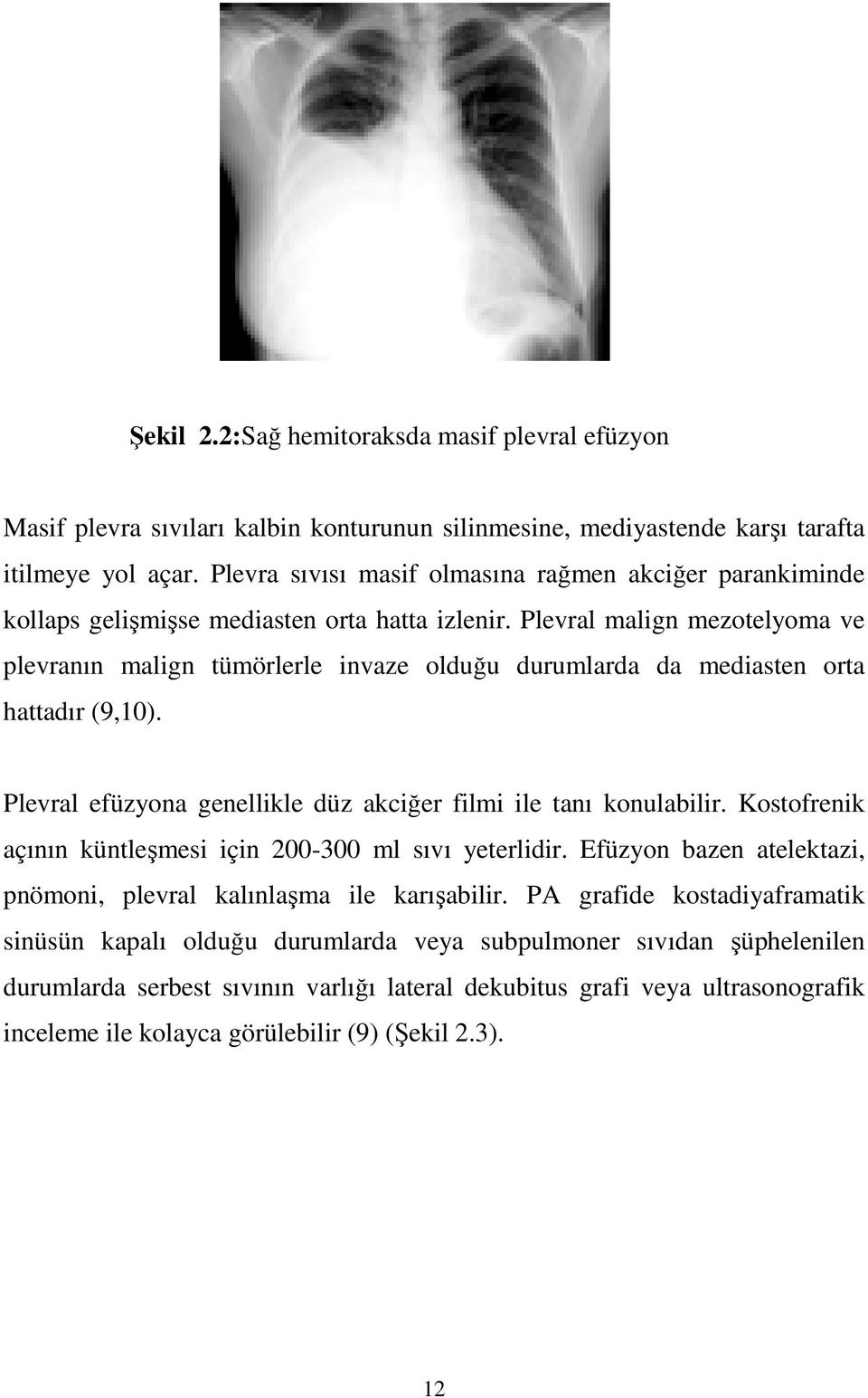 Plevral malign mezotelyoma ve plevranın malign tümörlerle invaze olduğu durumlarda da mediasten orta hattadır (9,10). Plevral efüzyona genellikle düz akciğer filmi ile tanı konulabilir.
