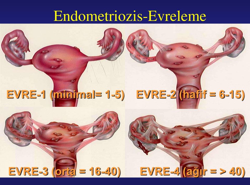 EVRE-2 (hafif = 6-15)