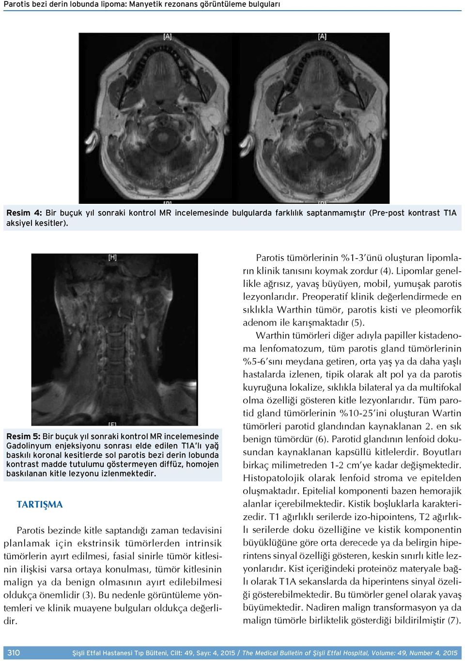 Resim 5: Bir buçuk yıl sonraki kontrol MR incelemesinde Gadolinyum enjeksiyonu sonrası elde edilen T1A lı yağ baskılı koronal kesitlerde sol parotis bezi derin lobunda kontrast madde tutulumu