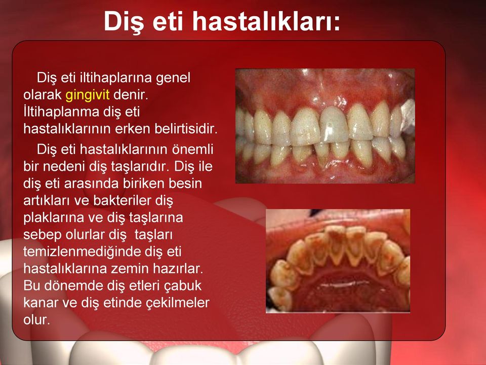 Diş eti hastalıklarının önemli bir nedeni diş taşlarıdır.