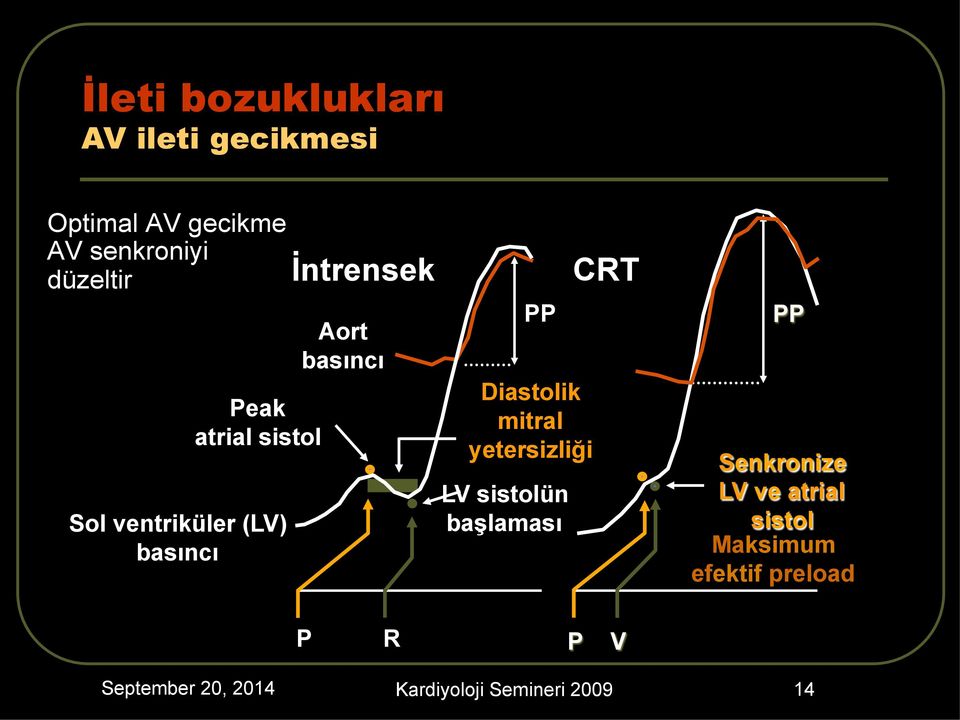 Diastolik mitral yetersizliği LV sistolün başlaması CRT PP Senkronize LV ve