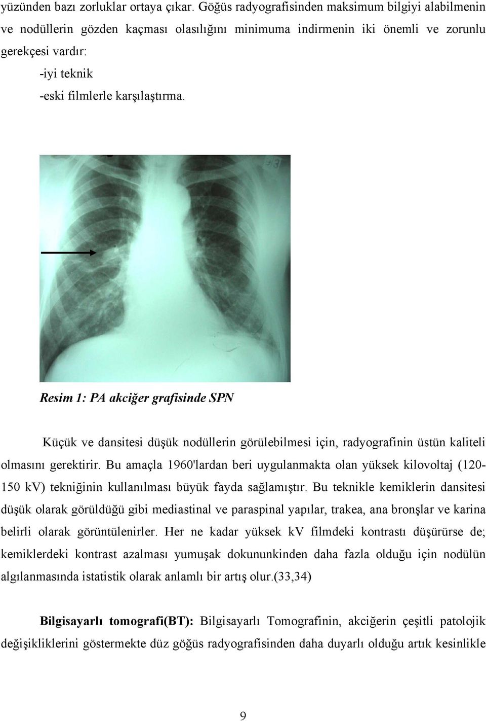 Resim 1: PA akciğer grafisinde SPN Küçük ve dansitesi düşük nodüllerin görülebilmesi için, radyografinin üstün kaliteli olmasını gerektirir.