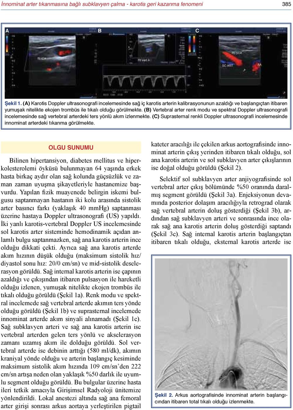 (B) Vertebral arter renk modu ve spektral Doppler ultrasonografi incelemesinde sağ vertebral arterdeki ters yönlü akım izlenmekte.