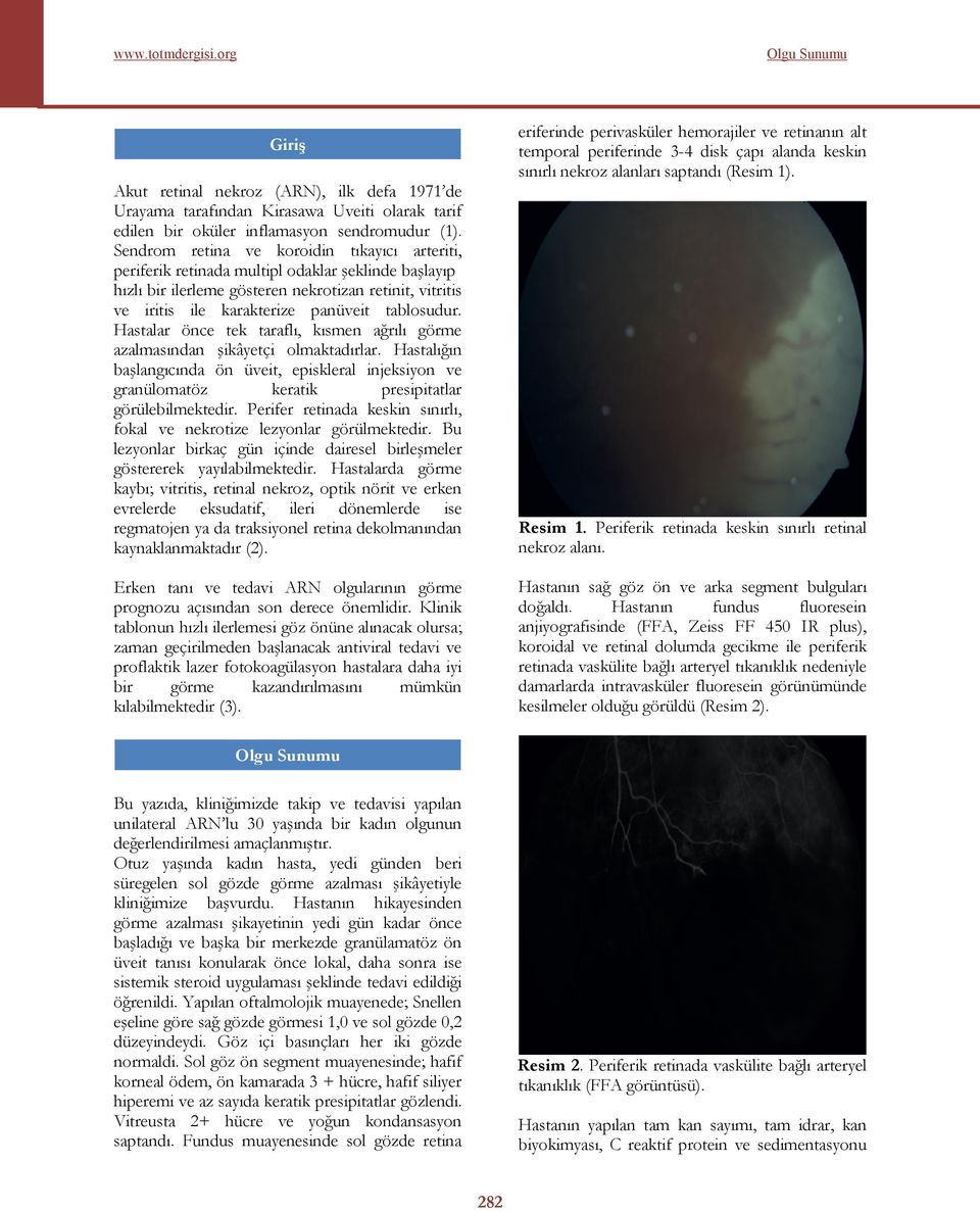 Sendrom retina ve koroidin tıkayıcı arteriti, periferik retinada multipl odaklar şeklinde başlayıp hızlı bir ilerleme gösteren nekrotizan retinit, vitritis ve iritis ile karakterize panüveit