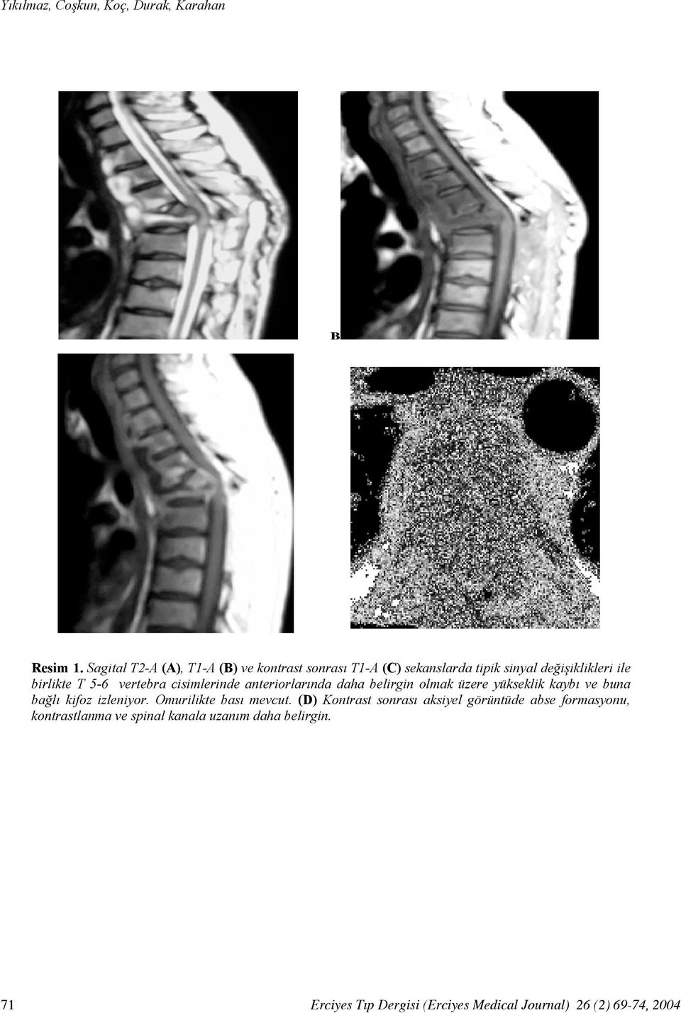 vertebra cisimlerinde anteriorlarında daha belirgin olmak üzere yükseklik kaybı ve buna bağlı kifoz izleniyor.