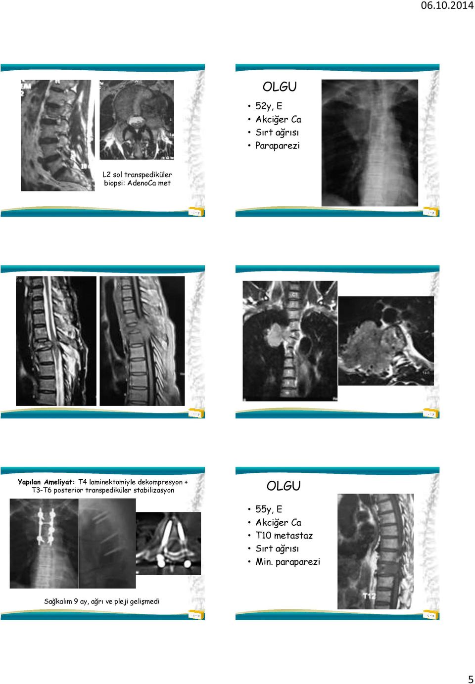 + T3-T6 posterior transpediküler stabilizasyon 55y, E Akciğer Ca T10