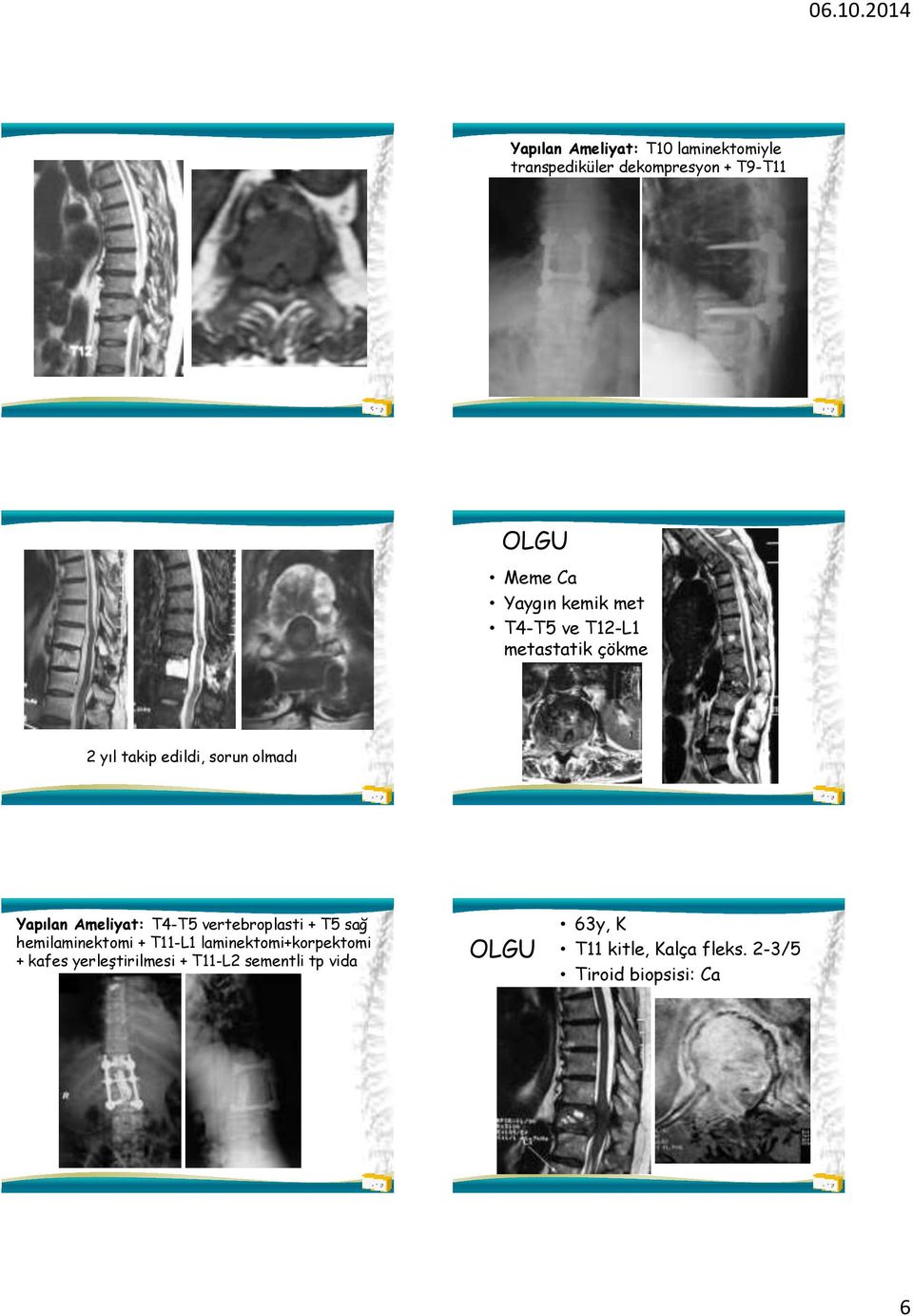 Ameliyat: T4-T5 vertebroplasti + T5 sağ hemilaminektomi + T11-L1 laminektomi+korpektomi + kafes