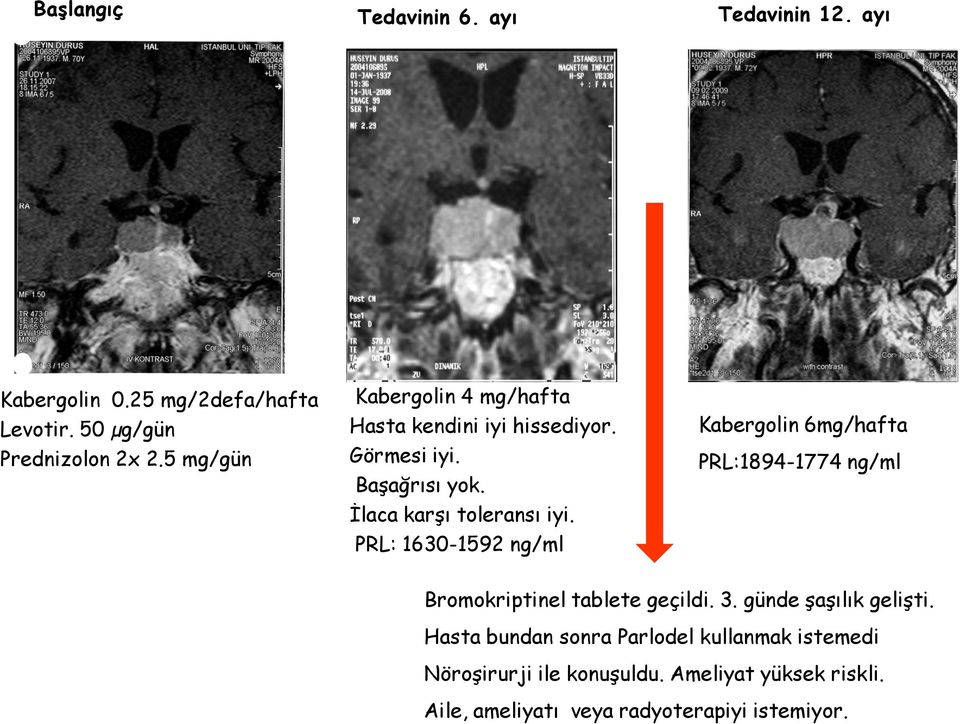 PRL: 1630-1592 ng/ml Kabergolin 6mg/hafta PRL:1894-1774 ng/ml Bromokriptinel tablete geçildi. 3. günde şaşılık gelişti.