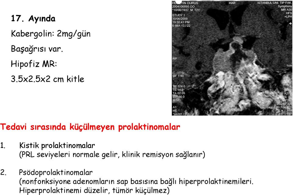 Kistik prolaktinomalar (PRL seviyeleri normale gelir, klinik remisyon sağlanır) 2.