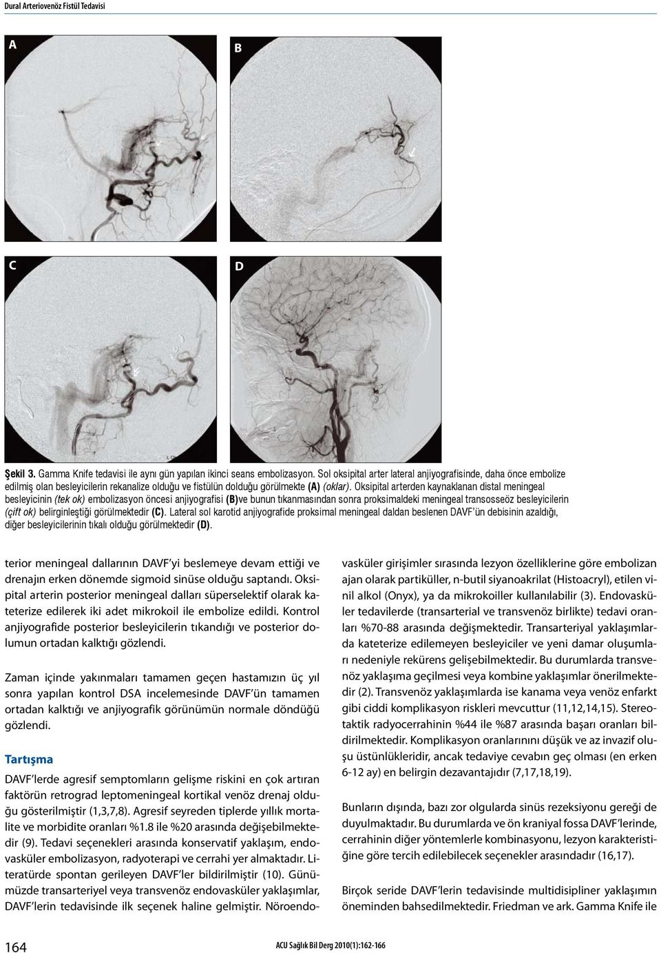 Oksipital arterden kaynaklanan distal meningeal besleyicinin (tek ok) embolizasyon öncesi anjiyografisi ()ve bunun tıkanmasından sonra proksimaldeki meningeal transosseöz besleyicilerin (çift ok)