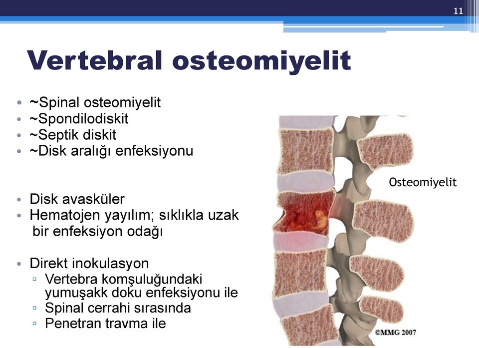 uzak bir enfeksiyon odağı Osteomiyelit Direkt inokulasyon Vertebra