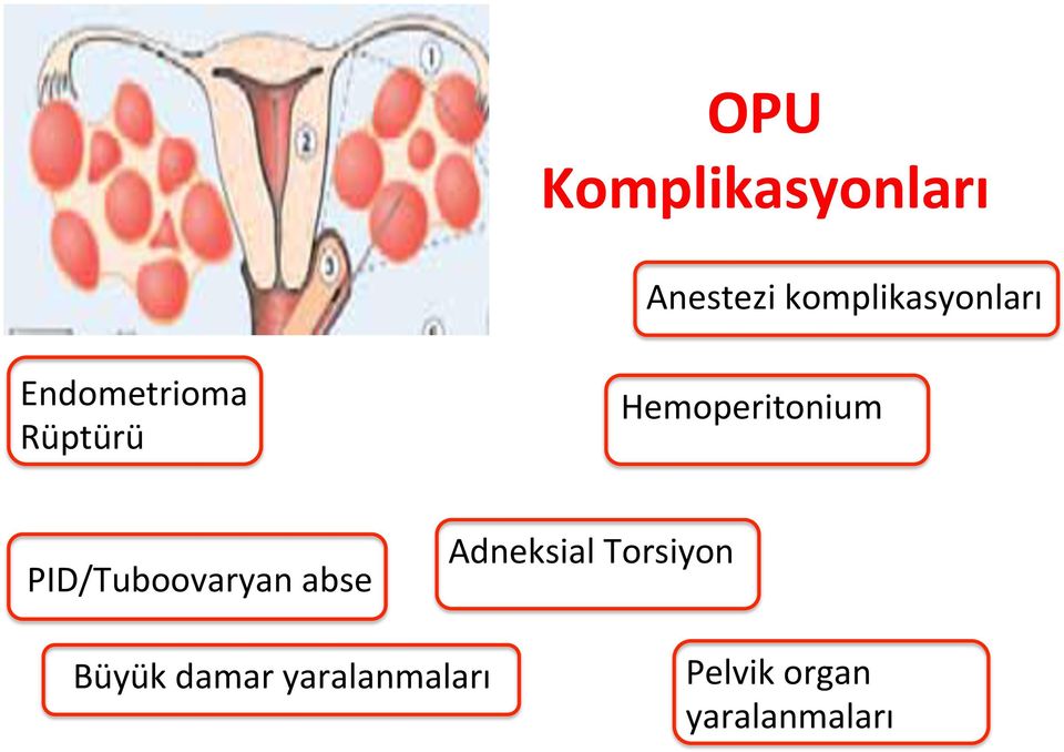 Hemoperitonium PID/Tuboovaryan abse