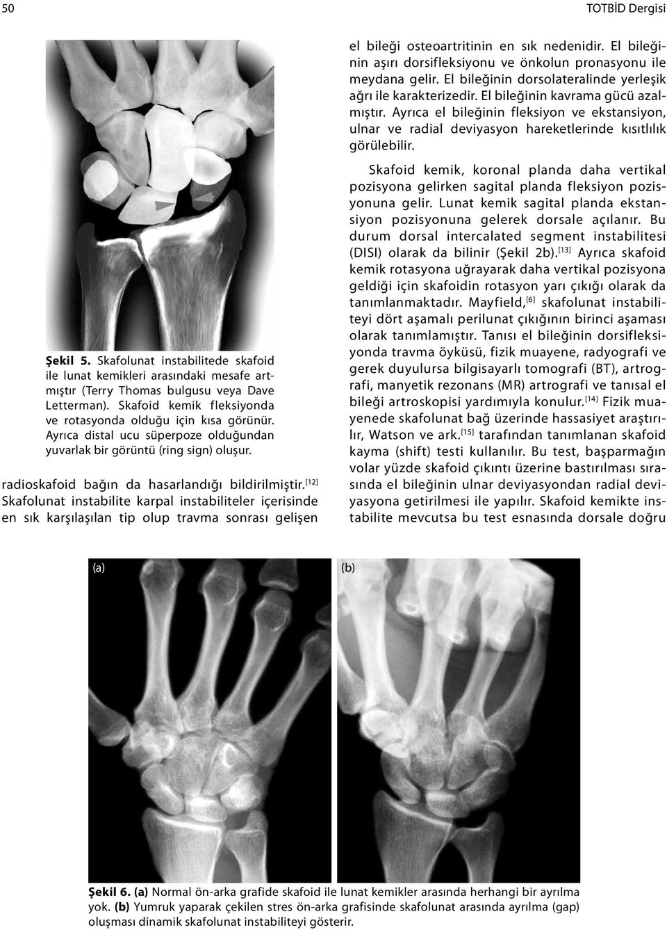 [12] Skafolunat instabilite karpal instabiliteler içerisinde en sık karşılaşılan tip olup travma sonrası gelişen el bileği osteoartritinin en sık nedenidir.