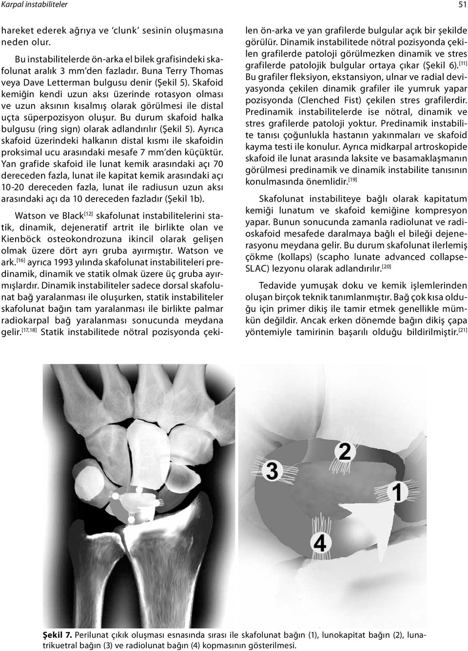 Bu durum skafoid halka bulgusu (ring sign) olarak adlandırılır (Şekil 5). Ayrıca skafoid üzerindeki halkanın distal kısmı ile skafoidin proksimal ucu arasındaki mesafe 7 mm den küçüktür.