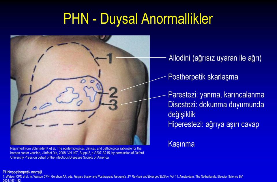 Suppl 2, p S207-S215, by permission of Oxford University Press on behalf of the Infectious Diseases Society of America. Kaşınma PHN=postherpetik nevralji. 1.