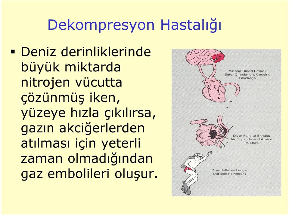 yüzeye hızla çıkılırsa, gazın akciğerlerden