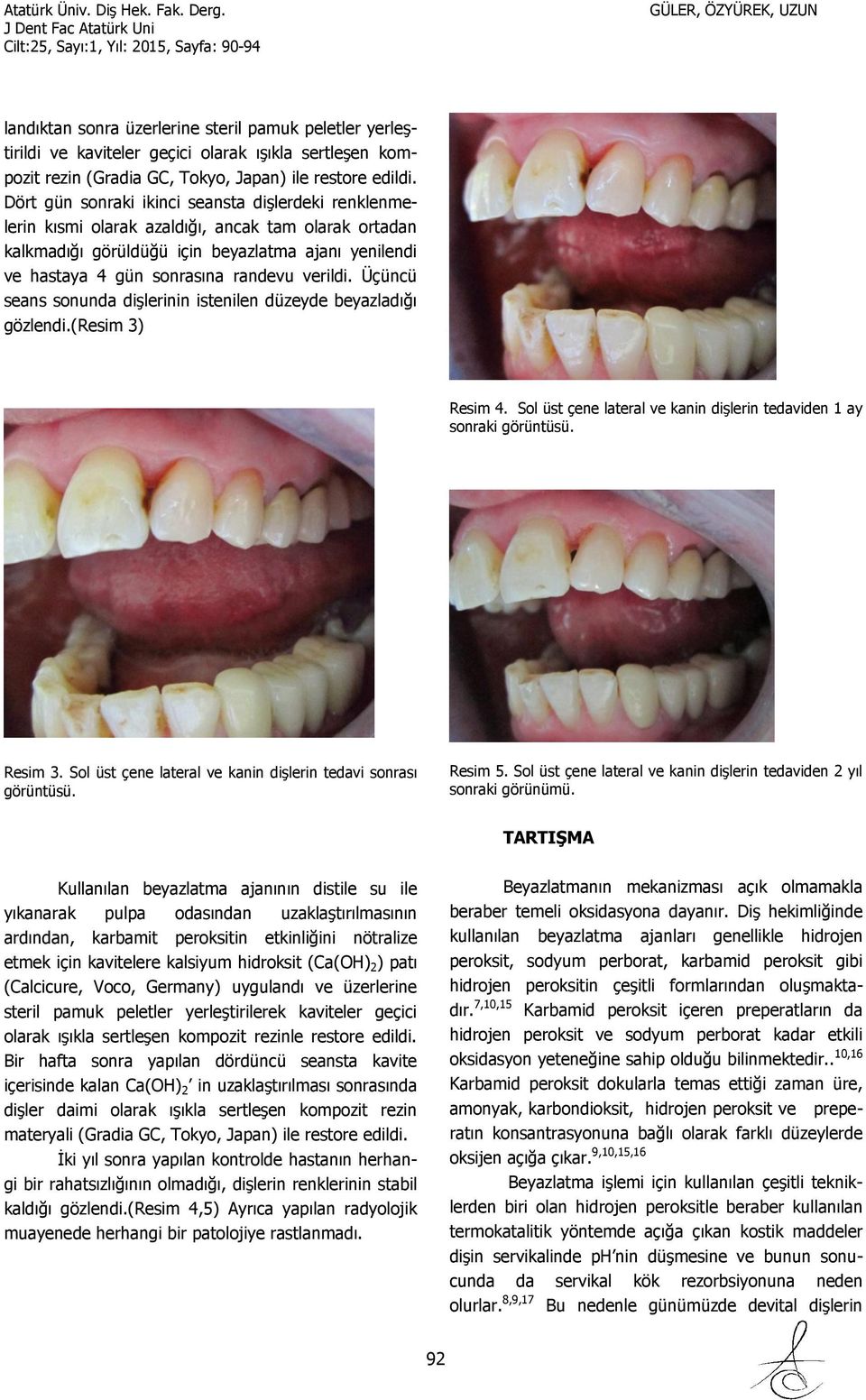verildi. Üçüncü seans sonunda dişlerinin istenilen düzeyde beyazladığı gözlendi.(resim 3) Resim 4. Sol üst çene lateral ve kanin dişlerin tedaviden 1 ay sonraki görüntüsü. Resim 3.