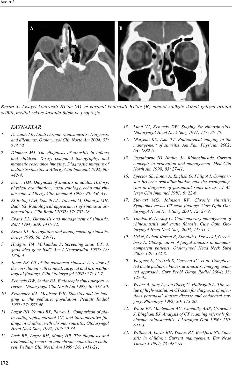 The diagnosis of sinusitis in infants and children: X-ray, computed tomography, and magnetic resonance imaging. Diagnostic imaging of pediatric sinusitis. J Allergy Clin Immunol 1992; 90: 442-4. 3.