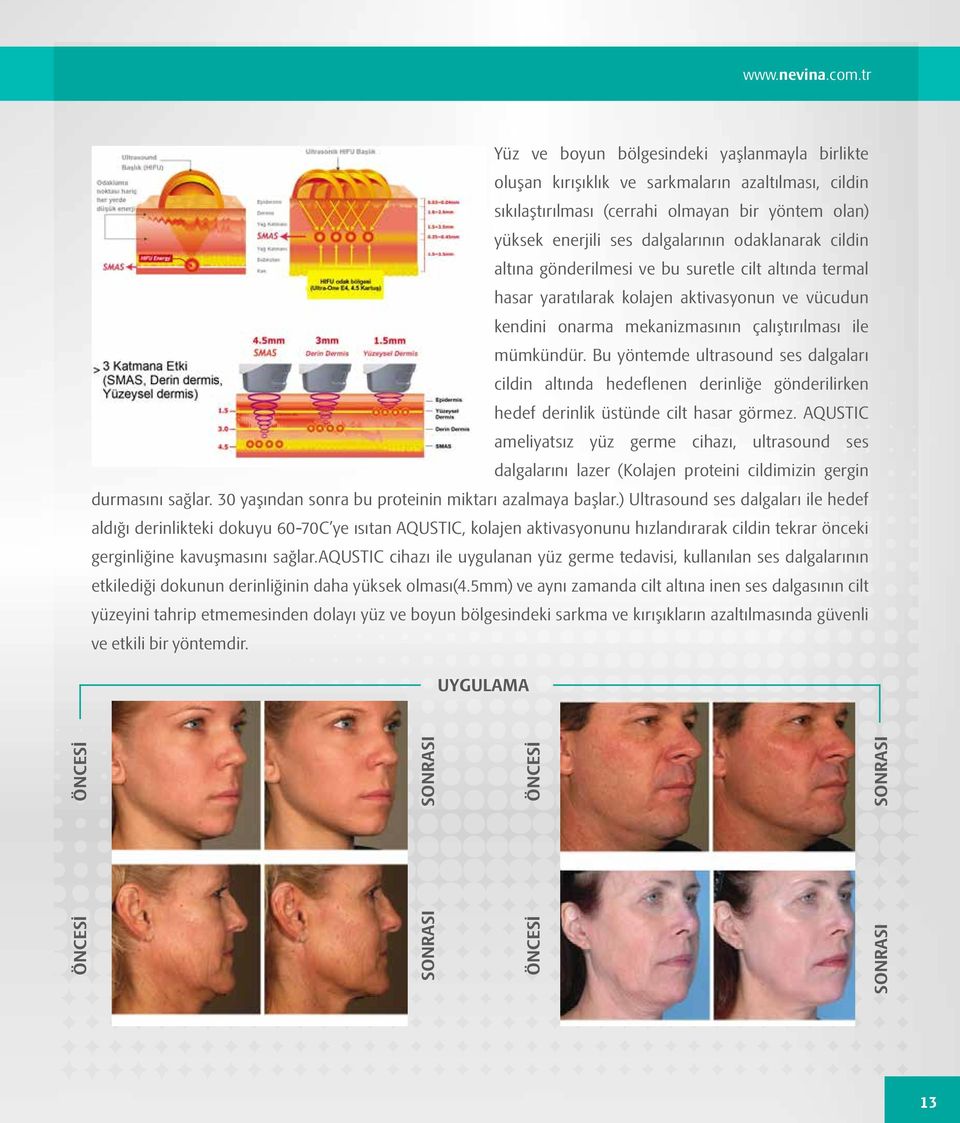 cildin altına gönderilmesi ve bu suretle cilt altında termal hasar yaratılarak kolajen aktivasyonun ve vücudun kendini onarma mekanizmasının çalıştırılması ile mümkündür.