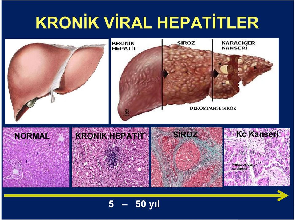 SİROZ NORMAL KRONİK