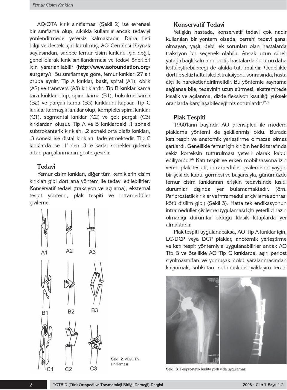 (http://www.aofoundation.org/ surgery/). Bu sınıflamaya göre, femur kırıkları 27 alt gruba ayrılır. Tip A kırıklar, basit, spiral (A1), oblik (A2) ve transvers (A3) kırıklardır.