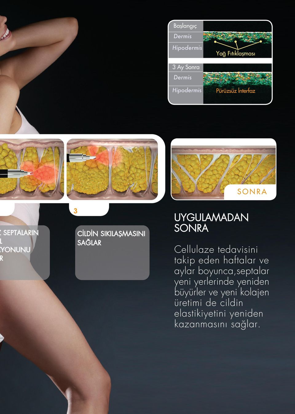 Cellulaze tedavisini takip eden haftalar ve aylar boyunca,septalar yeni yerlerinde