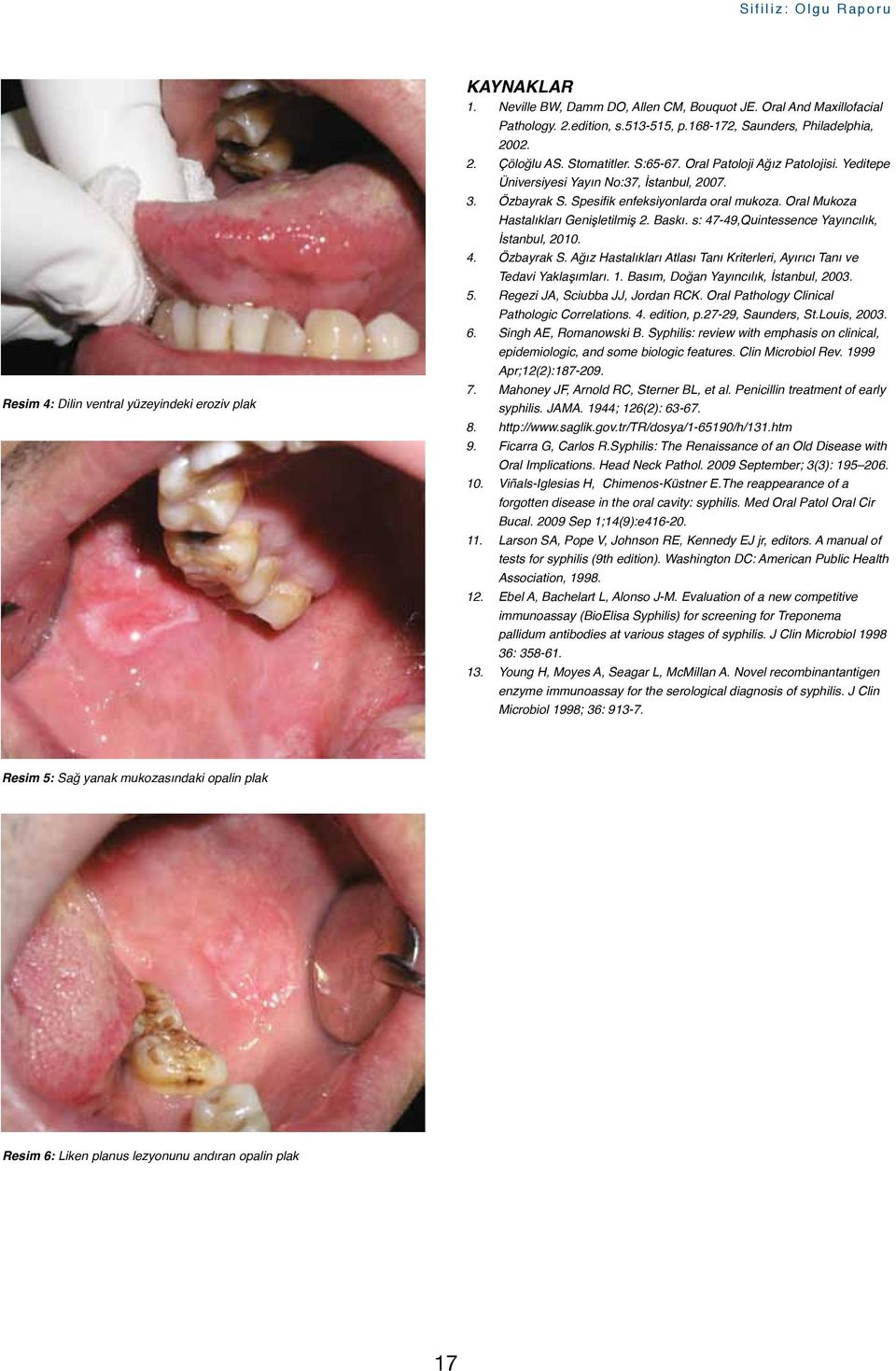 Spesifik enfeksiyonlarda oral mukoza. Oral Mukoza Hastalıkları Genişletilmiş 2. Baskı. s: 47-49,Quintessence Yayıncılık, İstanbul, 2010. 4. Özbayrak S.