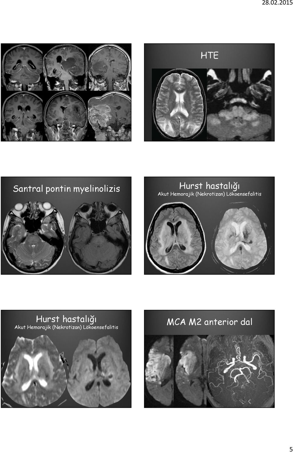 hastalığı Akut Hemorajik (Nekrotizan)