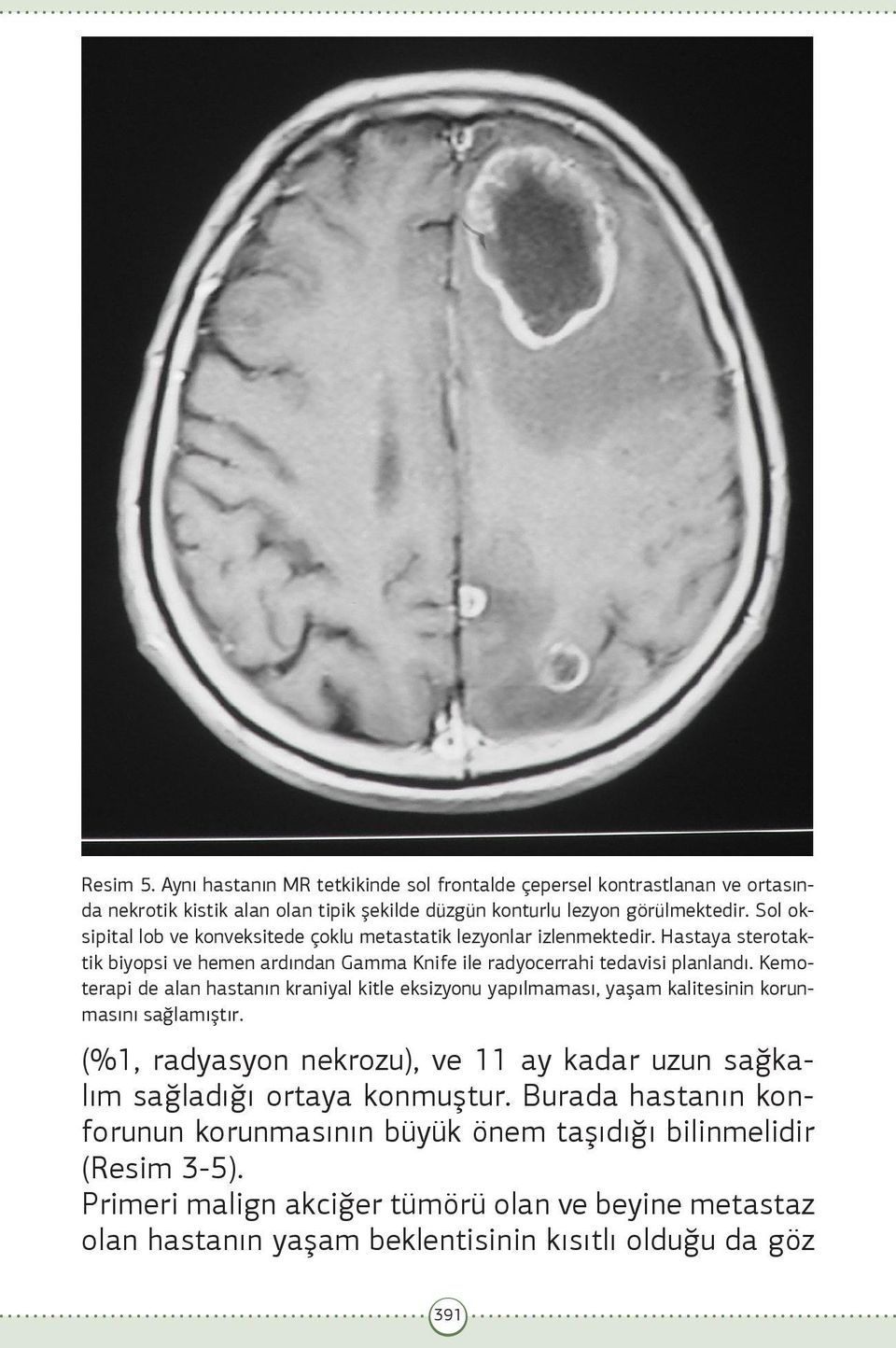 Kemoterapi de alan hastanın kraniyal kitle eksizyonu yapılmaması, yaşam kalitesinin korunmasını sağlamıştır.