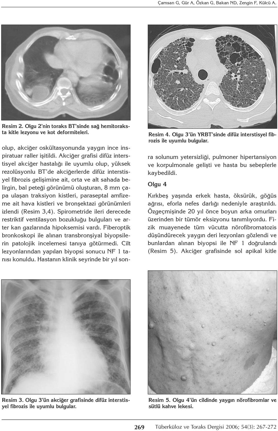 Akciğer grafisi difüz interstisyel akciğer hastalığı ile uyumlu olup, yüksek rezolüsyonlu BT de akciğerlerde difüz interstisyel fibrozis gelişimine ait, orta ve alt sahada belirgin, bal peteği