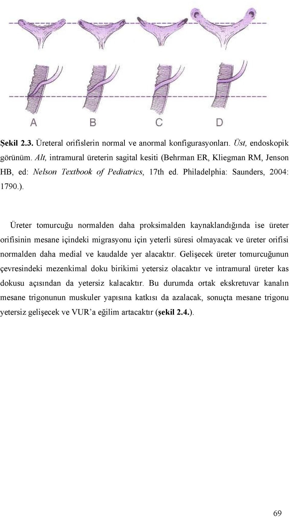 Üreter tomurcuğu normalden daha proksimalden kaynaklandığında ise üreter orifisinin mesane içindeki migrasyonu için yeterli süresi olmayacak ve üreter orifisi normalden daha medial ve kaudalde yer