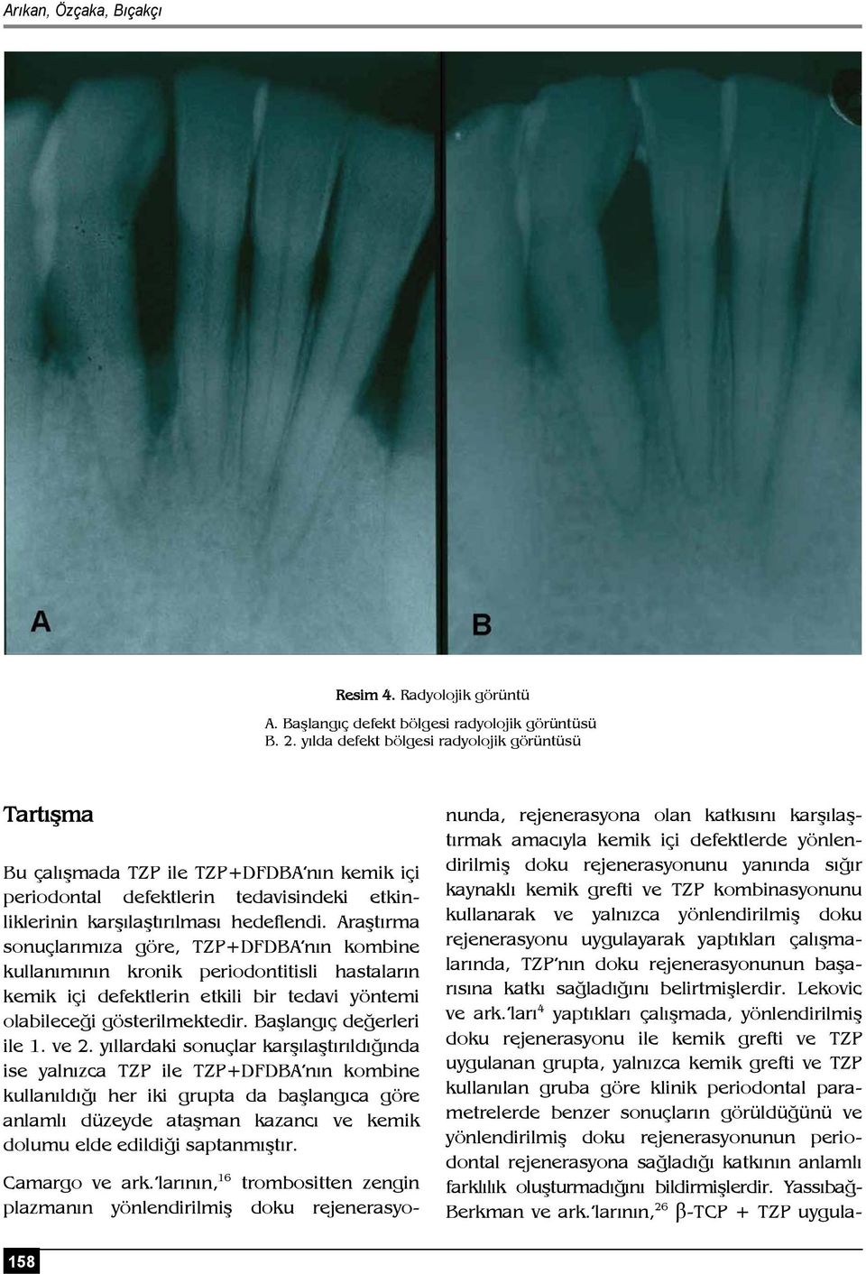 Araştırma sonuçlarımıza göre, TZP+DFDBA nın kombine kullanımının kronik periodontitisli hastaların kemik içi defektlerin etkili bir tedavi yöntemi olabileceği gösterilmektedir.