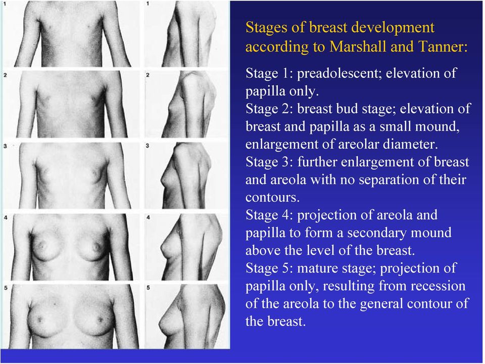 Stage 3: further enlargement of breast and areola with no separation of their contours.