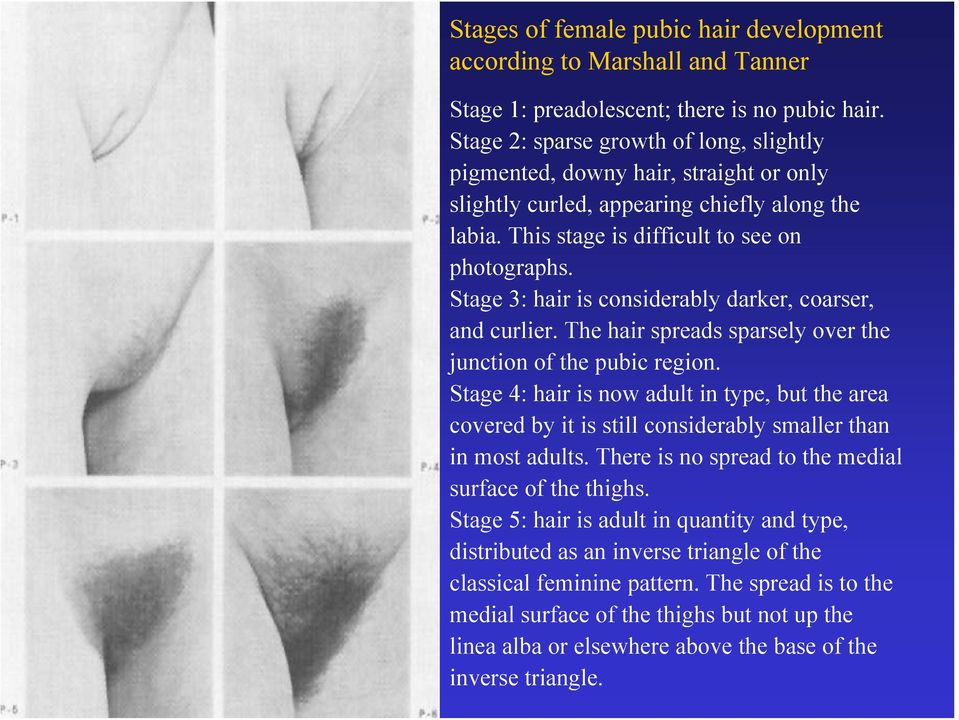 Stage 3: hair is considerably darker, coarser, and curlier. The hair spreads sparsely over the junction of the pubic region.